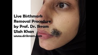 Laser Beauty in Action Watch Birthmark Removal Live lasertherapy live birthmarkremoval [upl. by Ynnhoj]