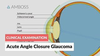 Acute Angle Closure Glaucoma [upl. by Aerol]