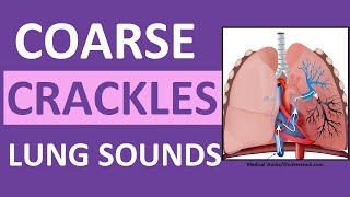 Crackles Coarse Lung Sounds  Crackles and Rales Breath Sounds Abnormal [upl. by Vasya]