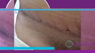 Abdominoplastia  Proceso de cicatrización [upl. by Hearsh]