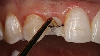 Direct Resin Bonded Bridge  Dental Online Training [upl. by Blackmun315]