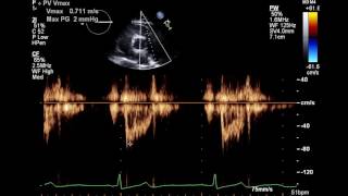 Normal Complete 2D Echocardiogram with Color Doppler and Spectral Doppler [upl. by Atrice]