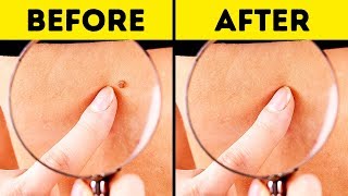 10 Effective Ways to Remove Skin Tags Naturally [upl. by Pytlik132]