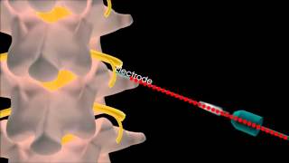 Lumbar Radiofrequency treatment [upl. by Terencio]