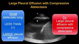 Lung Ultrasound Consolidation  Atelectasis or Pneumonia [upl. by Tadio274]