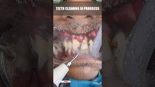 Teeth Scaling Procedure  Tartar Removal  Teeth Whitening  Dental Cleaning  Teeth Cleaning short [upl. by Eanyl]