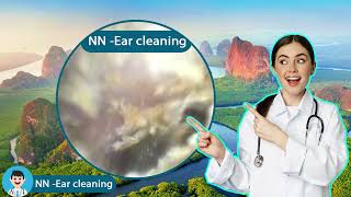 Ear endoscopy cleaning for several childrens ears [upl. by Laucsap]