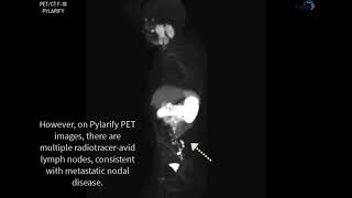 PSMA PETCT PYLARIFY Case 2 [upl. by Newol]