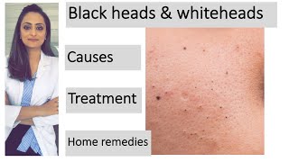 How to remove blackheads amp whiteheads Causes Treatment  Home remedies dermatologist [upl. by Nogras]