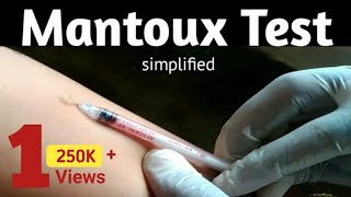 Mantoux Test to diagnosis TB infection  MT or TST or PPD Principle and Procedure [upl. by Fabio]