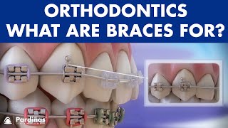 How Braces Work Elements of the orthodontic treatment and its role © [upl. by Sandstrom207]