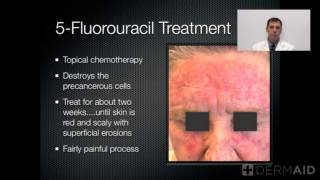 Actinic Keratosis Fluorouracil Treatment 27Day Time Lapse [upl. by Brownson]