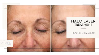 Halo Laser Treatment I What to Expect [upl. by Swane]