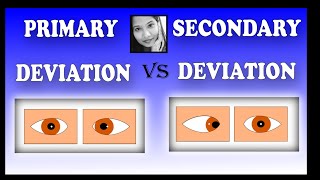 Primary Deviation Vs Secondary Deviation  Squint Simplied for Medical Students [upl. by Naelcm]