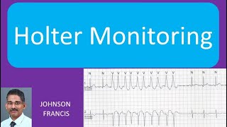 Holter Monitoring [upl. by Anigar]