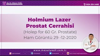 HoLEP Full Length Video 60 cc prostate Holmium Laser Enucleation of Prostate [upl. by Emmerie610]