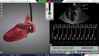 HeartWorks Global Left Ventricular Dysfunction [upl. by Zeralda]