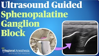 Ultrasound Guided Sphenopalatine Ganglion Block [upl. by Eiro]