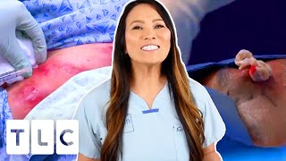 The Top 3 Most Watched Pimple Popping Moments  Dr Pimple Popper [upl. by Annasus]