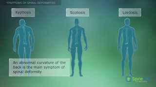 Spinal Deformities Symptoms [upl. by Aspa]