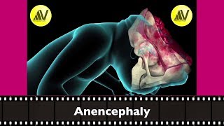 Anencephaly Explained [upl. by Arny]