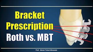 Using Roth and MBT brackets [upl. by Nina670]