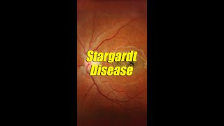 Stargardt disease [upl. by Kinsler219]