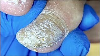 Pedicure TutorialThickhard toenailit is really hard to trim【foot care】 [upl. by Hazen]