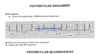 Ventricular Bigeminy Trigeminy amp Quadrigeminy [upl. by Laersi]