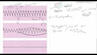 Comparing ventricular rhythms [upl. by Artimed]