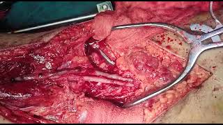 brachial artery repair [upl. by Lebar]