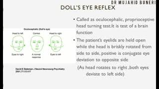 Dolls Eye Reflex  Oculocephalic Reflex  Brain death  Dr M B [upl. by Akirahs756]