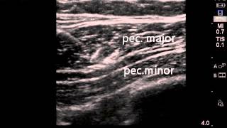 Ultrasound guided PECS 1 block [upl. by Adala]