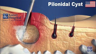 EPSiT  Endoscopic Pilonidal Sinus Treatment [upl. by Elok]