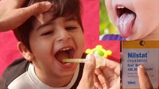 Treat Oral Thrush At Home [upl. by Akkeber926]