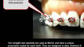 How important is the position of your orthodontic braces [upl. by Vorster]