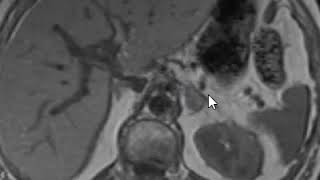 Adrenal adenoma in and out of phase imaging [upl. by Cyprian]