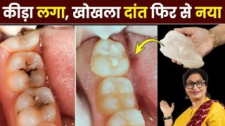 सिर्फ 5 मिनट ये काम करो कीड़ा लगा खोखला दांत भी फिर से नए जैसा हो जायेगा  Remedy For Teeth Cavity [upl. by Repooc804]