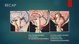 ArnoldChiari 1 Malformation [upl. by Podvin240]