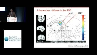 Vibhor Krishna  FUS thalamotomy for the prevention of secondary generalization in epilepsy 2018 [upl. by Marcelo267]