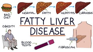 Understanding NonAlcoholic Fatty Liver Disease [upl. by Halford989]