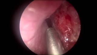 WEGNERS Granulomatosis of the Nasal Septum [upl. by Almeda]