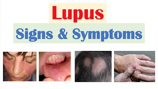 Lupus Signs amp Symptoms amp Why They Occur  Skin Joints Organ Systems [upl. by Gert]