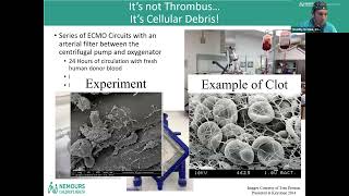 Hemolysis in Pediatric ECLS [upl. by Kenley498]