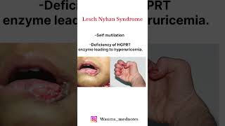 Lesch Nyhan Syndrome High yield Topic  🔥🔥💯💯 fmge shorts [upl. by Hurd]