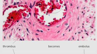 MedDef29 Thrombus vs Embolus [upl. by Angele]