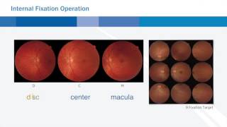 Topcon TRC NW400 nonmydriatic fundus camera [upl. by Aniad299]