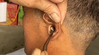 Removing ear blockage use manual tools [upl. by Siul456]