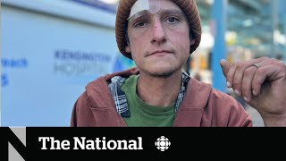 How a fleshrotting ‘zombie drug’ is complicating the overdose crisis [upl. by Ycnuahc]