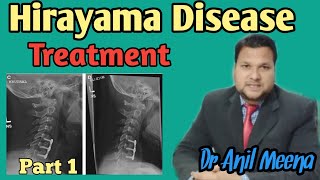 Hirayama Disease  hirayama Disease Treatment  Hirayama Disease Treatment and Exercise  in Hindi [upl. by Kuehn456]